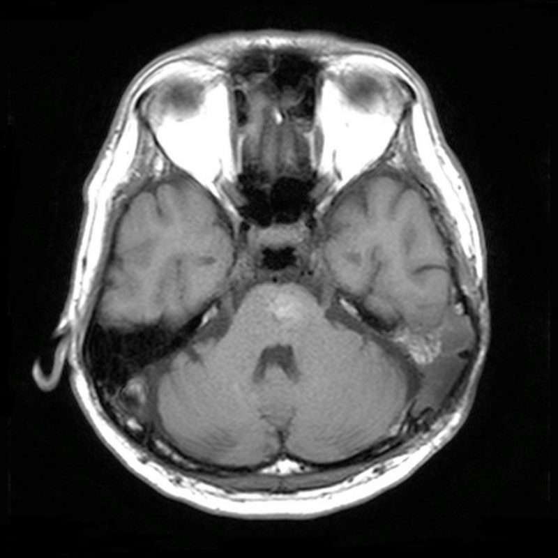 脳幹出血47歳男性のMRI実例画像　脳神経外科医　大森一美