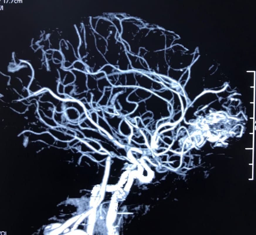 AVM 脳出血  20歳　男性　脳神経外科医　大森一美