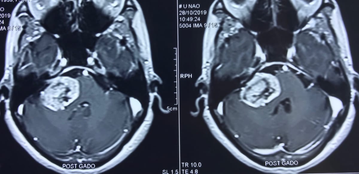 聴神経腫瘍60歳女性のMRI実例画像　脳神経外科医　大森一美