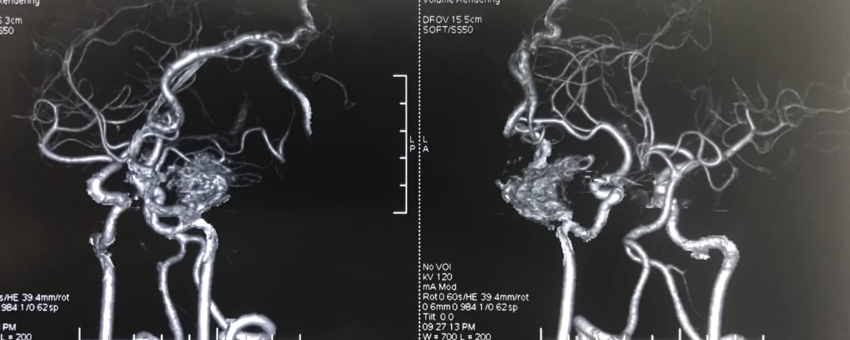 AVMによる脳出血17歳男性の実例画像　脳神経外科医　大森一美