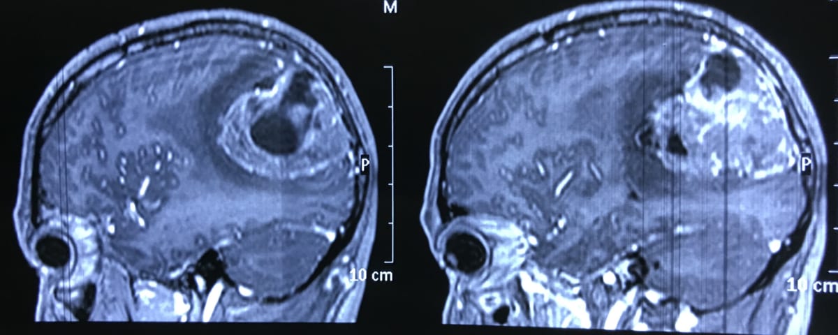脳腫瘍　40歳　男性　MRI実例画像　脳神経外科医　大森一美