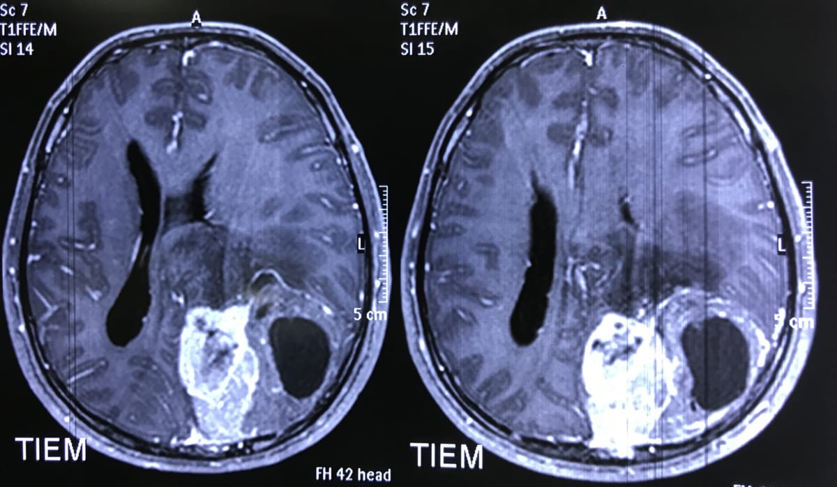 脳腫瘍40歳男性　MRI実例画像　脳神経外科医　大森一美