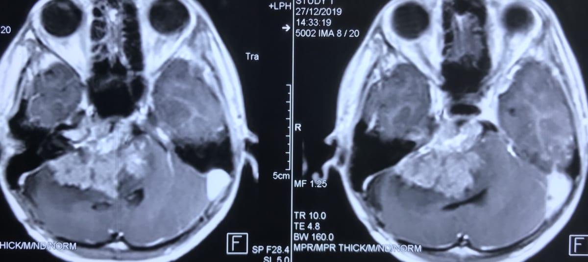 頭蓋底部髄膜腫12歳男性のMRI実例画像　脳神経外科医　大森一美