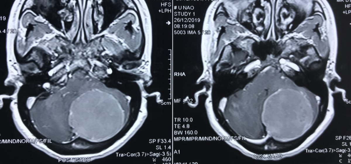 頭蓋底部腫瘍55歳女性のMRI実例画像　脳神経外科医　大森一美