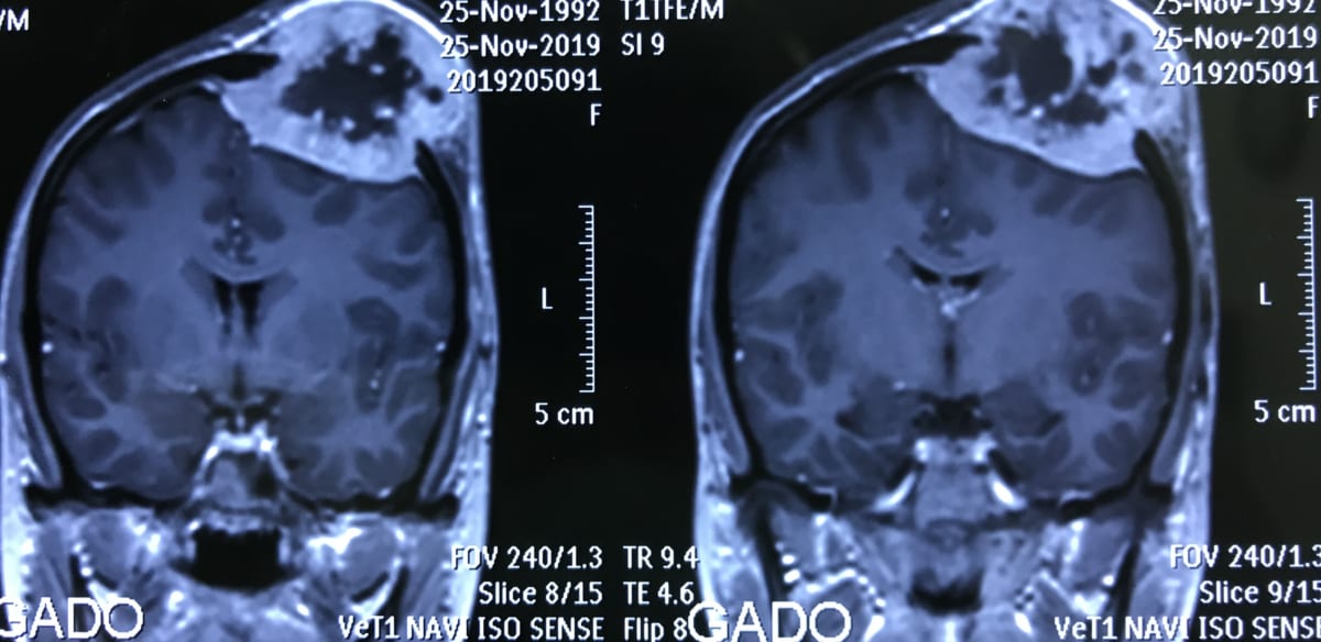 頭蓋骨腫瘍　27歳　女性 　脳神経外科医　大森一美