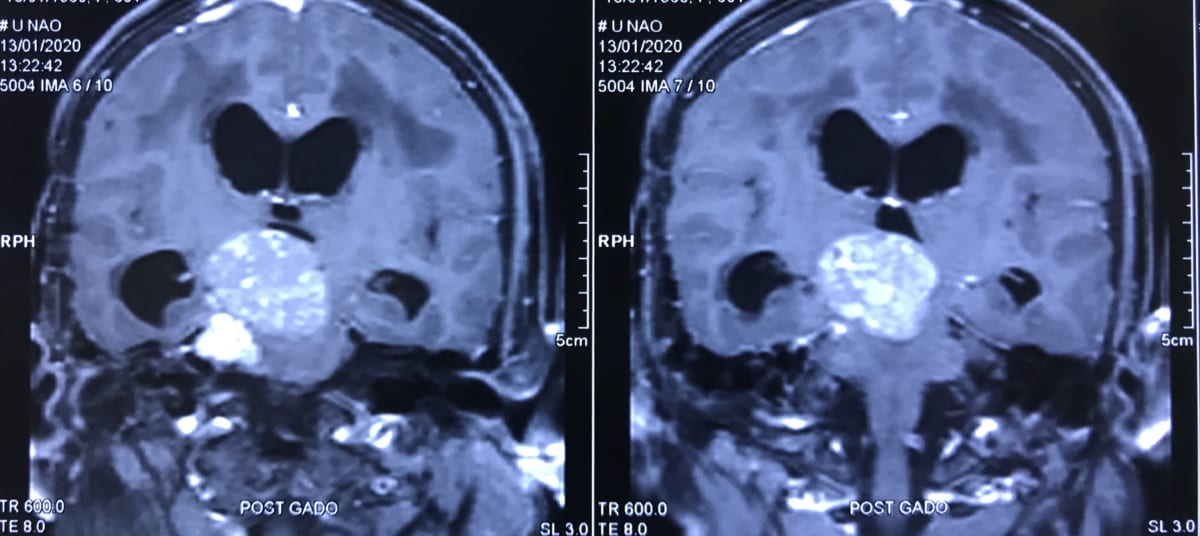 頭蓋底部髄膜腫　MRI　59歳　女性　脳神経外科医　大森一美