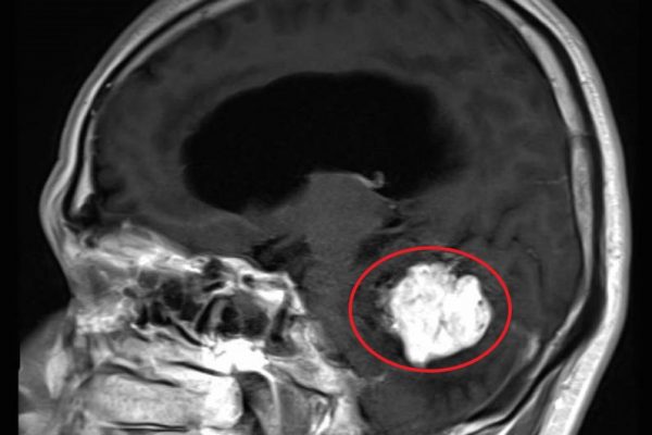 松果体近傍部腫瘍
