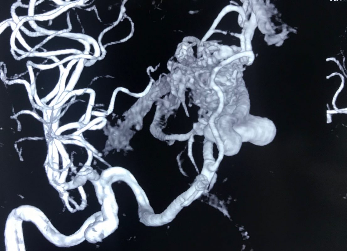 動静脈奇形（AVM）とは何かを知る