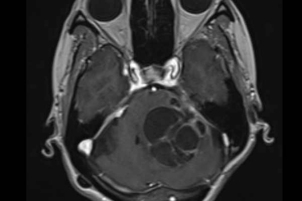 聴神経腫瘍（再発、巨大）