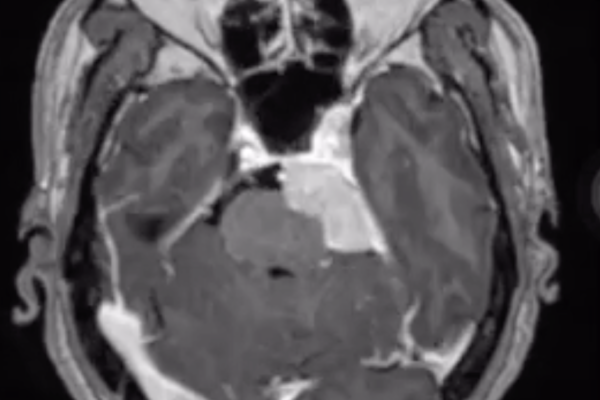 錐体斜台部髄膜腫