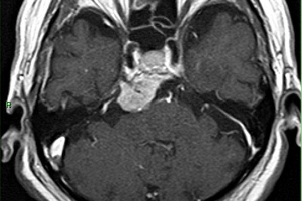 錐体斜台部髄膜腫