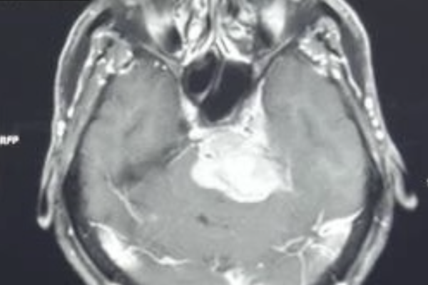 錐体斜台部髄膜腫