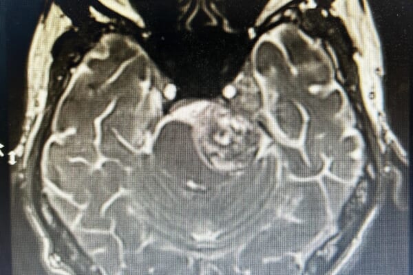 三叉神経鞘腫 Trigeminal neurinoma