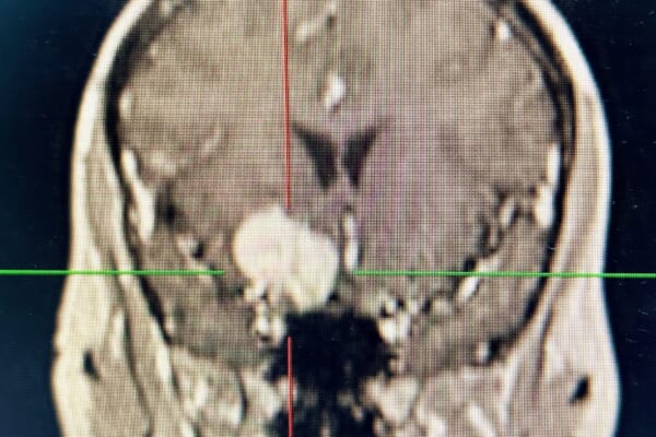 蝶形骨縁髄膜腫 sphenoid ridge meningioma