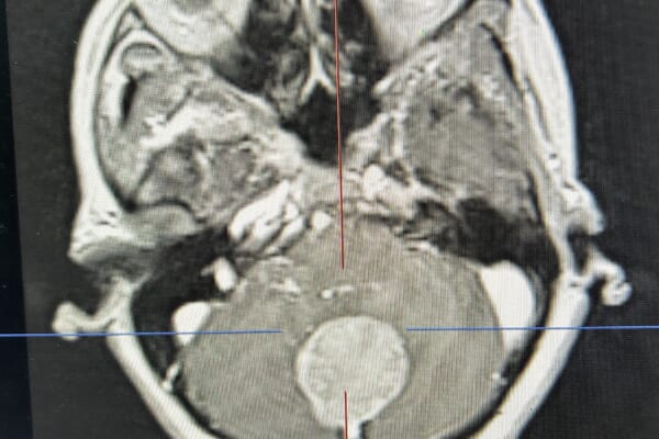 小脳鎌髄膜腫 falx cerebelli meningioma