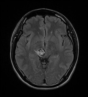 脳幹部海綿状血管腫　brainstem cavernoma  22歳　男性