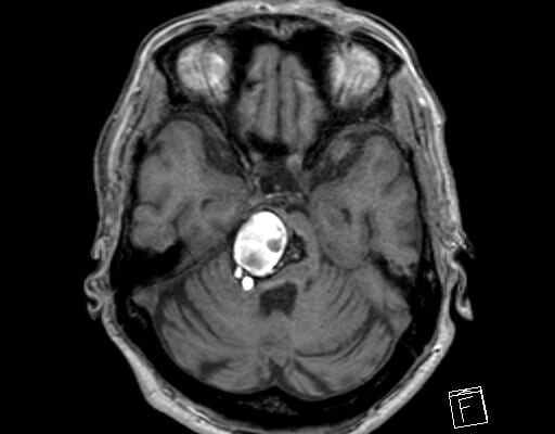 脳幹部海綿状血管腫　brainstem cavernoma  72歳　女性