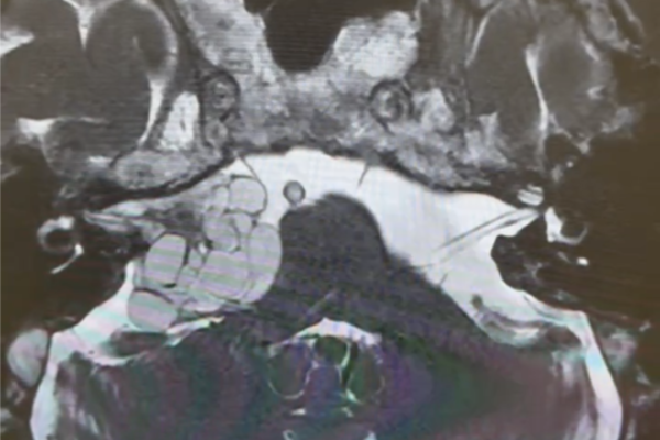 聴神経腫瘍  acoustic neurinoma 79歳　女性
