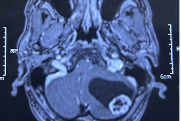 小脳血管芽腫 hemangioblastoma 20代　男性