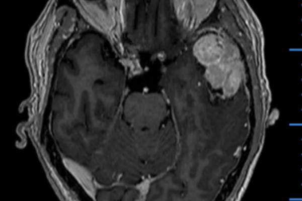 蝶形骨縁髄膜腫 shenoidridge meningioma 60代　男性