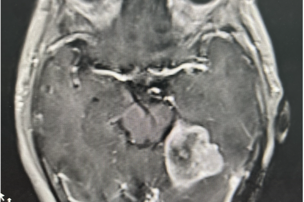 小脳テント髄膜腫 tentorium cerebelli meningioma 40代　男性　再発