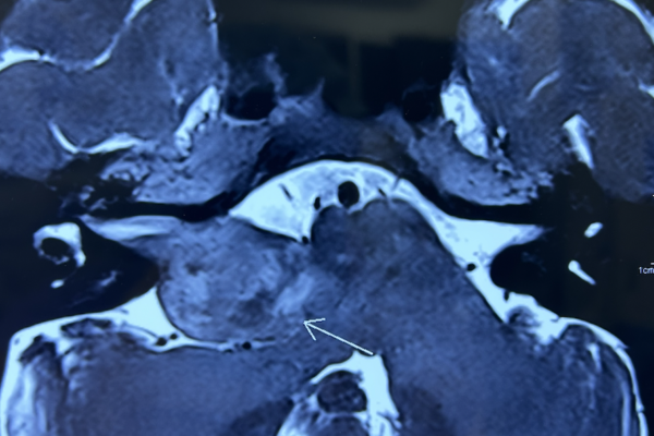 聴神経腫瘍 acoustic neurinoma 50代　女性