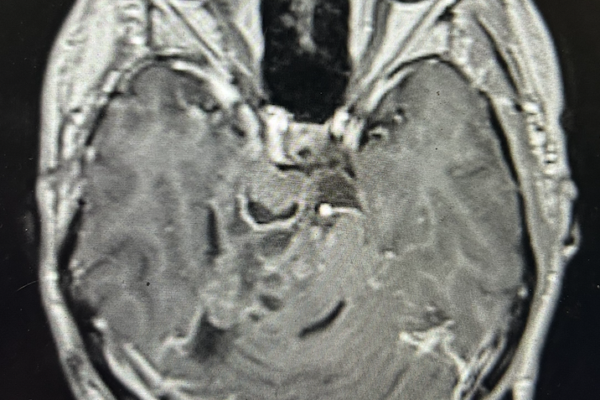 錐体斜台部腫瘍 petroclival tumor 20代　男性　再発
